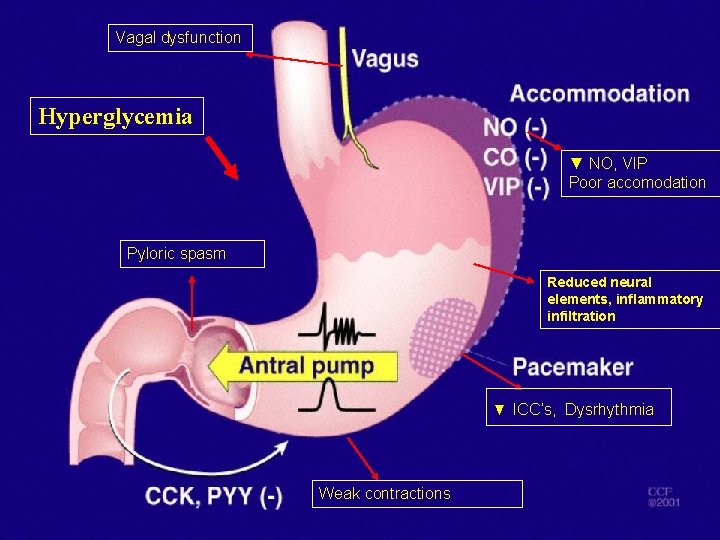 Vagal dysfunction Hyperglycemia ▼ NO, VIP Poor accomodation Pyloric spasm Reduced neural elements, inflammatory