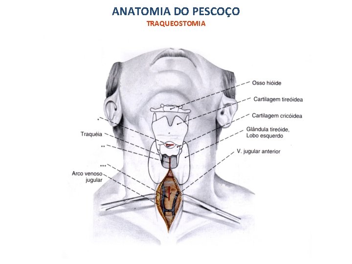 ANATOMIA DO PESCOÇO TRAQUEOSTOMIA 