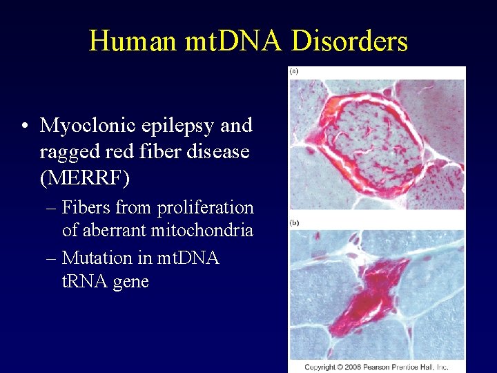 Human mt. DNA Disorders • Myoclonic epilepsy and ragged red fiber disease (MERRF) – Human mt. DNA Disorders • Myoclonic epilepsy and ragged red fiber disease (MERRF) –