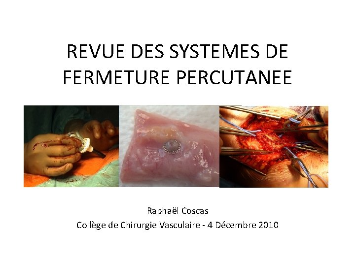 REVUE DES SYSTEMES DE FERMETURE PERCUTANEE Raphaël Coscas Collège de Chirurgie Vasculaire - 4 REVUE DES SYSTEMES DE FERMETURE PERCUTANEE Raphaël Coscas Collège de Chirurgie Vasculaire - 4