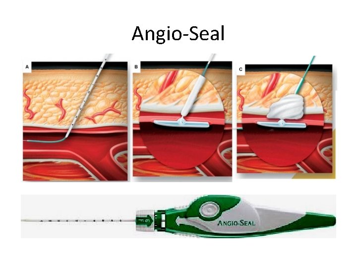 Angio-Seal • 6 Fr / 8 Fr • « Sandwich » • User-friendly Angio-Seal • 6 Fr / 8 Fr • « Sandwich » • User-friendly
