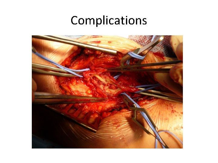 Complications Complications
