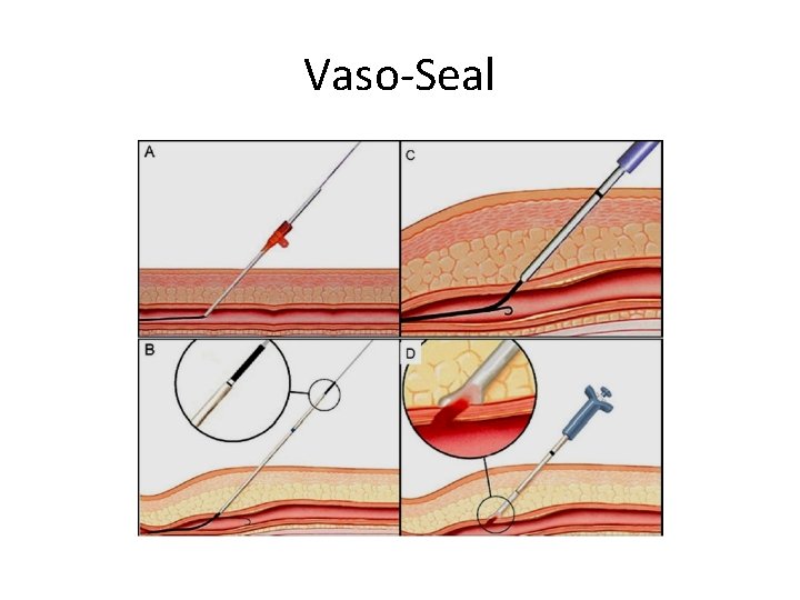 Vaso-Seal Vaso-Seal