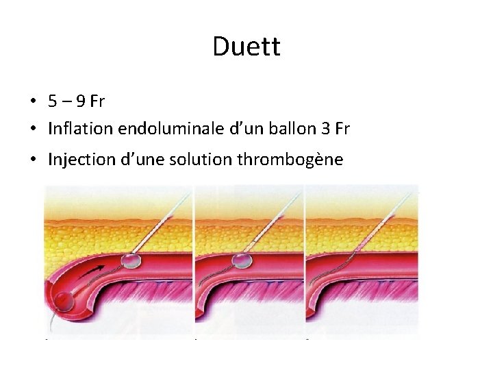 Duett • 5 – 9 Fr • Inflation endoluminale d’un ballon 3 Fr • Duett • 5 – 9 Fr • Inflation endoluminale d’un ballon 3 Fr •