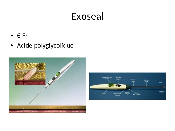 Exoseal • 6 Fr • Acide polyglycolique Exoseal • 6 Fr • Acide polyglycolique