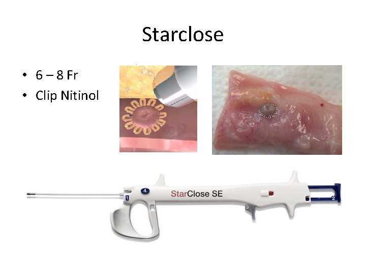 Starclose • 6 – 8 Fr • Clip Nitinol Starclose • 6 – 8 Fr • Clip Nitinol