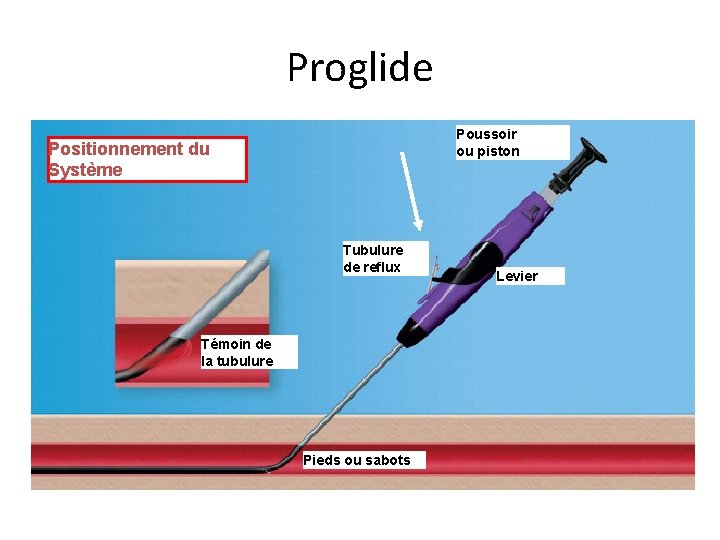 Proglide Poussoir ou piston Positionnement du Système Tubulure de reflux Témoin de la tubulure Proglide Poussoir ou piston Positionnement du Système Tubulure de reflux Témoin de la tubulure