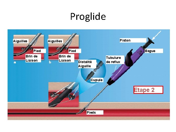Proglide Aiguilles Piston Aiguilles Pied Brin de Liaison Bague Distalité Aiguille Tubulure de reflux Proglide Aiguilles Piston Aiguilles Pied Brin de Liaison Bague Distalité Aiguille Tubulure de reflux