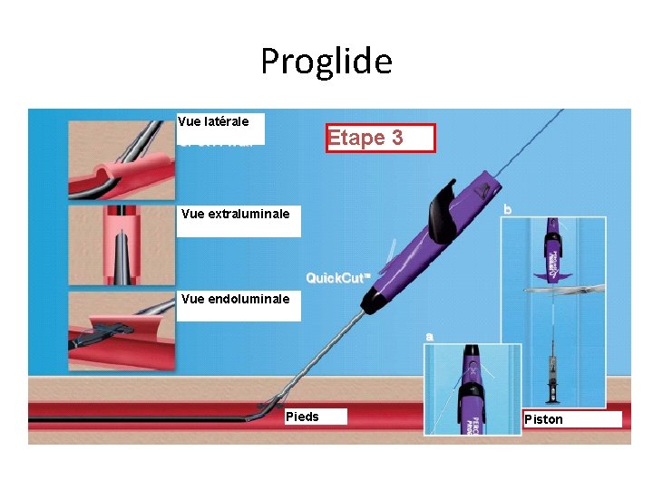Proglide Vue latérale Etape 3 Vue extraluminale Vue endoluminale Pieds Piston Proglide Vue latérale Etape 3 Vue extraluminale Vue endoluminale Pieds Piston