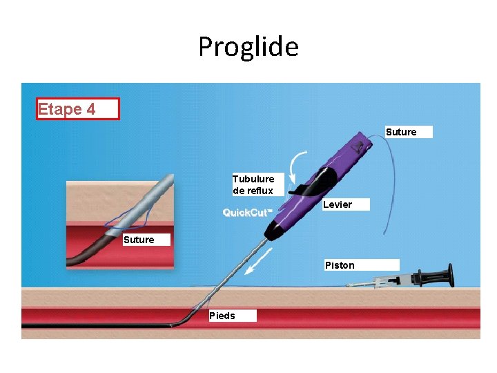 Proglide Etape 4 Suture Tubulure de reflux Levier Suture Piston Pieds Proglide Etape 4 Suture Tubulure de reflux Levier Suture Piston Pieds