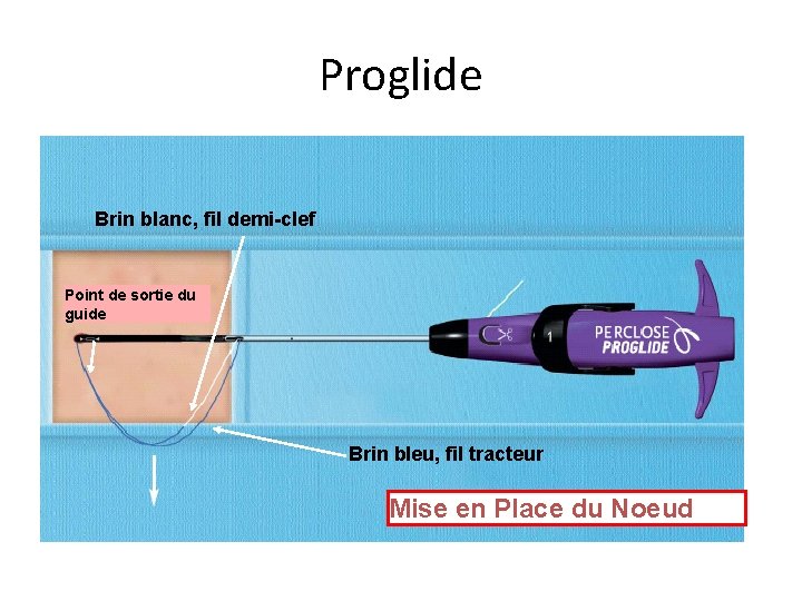 Proglide Brin blanc, fil demi-clef Point de sortie du guide Brin bleu, fil tracteur Proglide Brin blanc, fil demi-clef Point de sortie du guide Brin bleu, fil tracteur