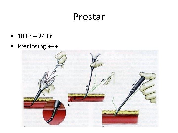 Prostar • 10 Fr – 24 Fr • Préclosing +++ Prostar • 10 Fr – 24 Fr • Préclosing +++