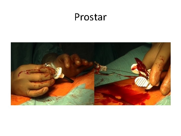 Prostar Prostar