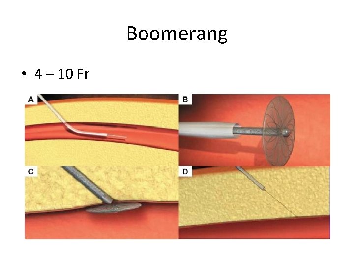 Boomerang • 4 – 10 Fr Boomerang • 4 – 10 Fr