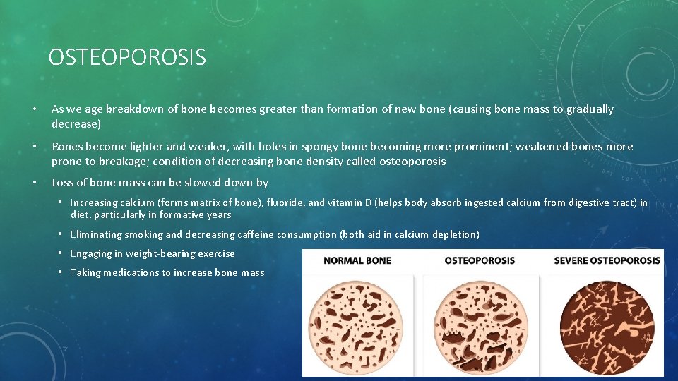 OSTEOPOROSIS • As we age breakdown of bone becomes greater than formation of new