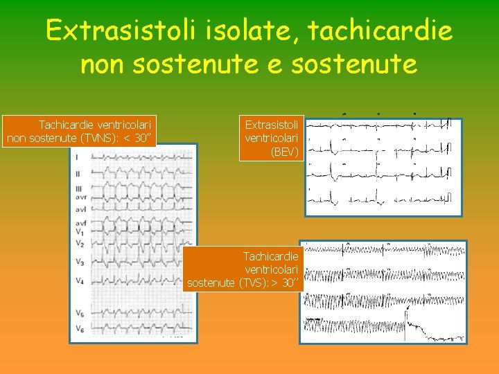 Extrasistoli isolate, tachicardie non sostenute e sostenute Tachicardie ventricolari non sostenute (TVNS): < 30’’ Extrasistoli isolate, tachicardie non sostenute e sostenute Tachicardie ventricolari non sostenute (TVNS): < 30’’