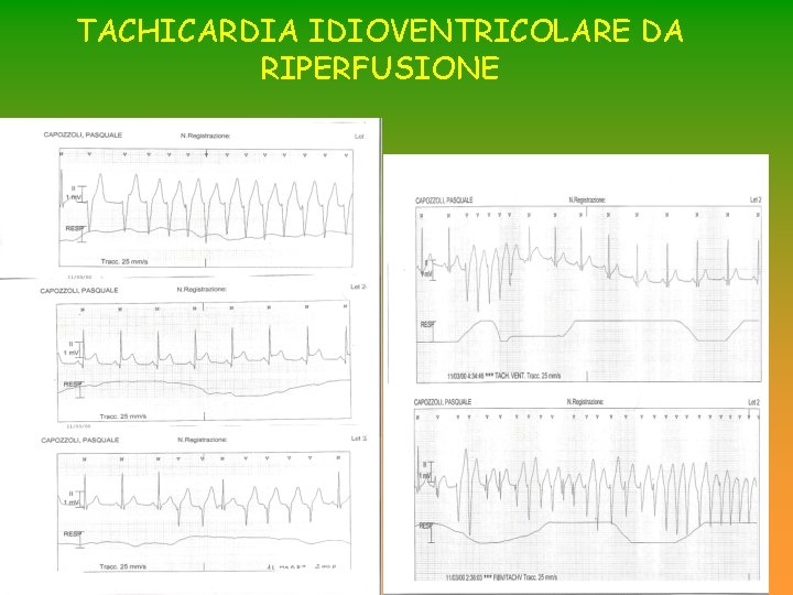 TACHICARDIA IDIOVENTRICOLARE DA RIPERFUSIONE TACHICARDIA IDIOVENTRICOLARE DA RIPERFUSIONE