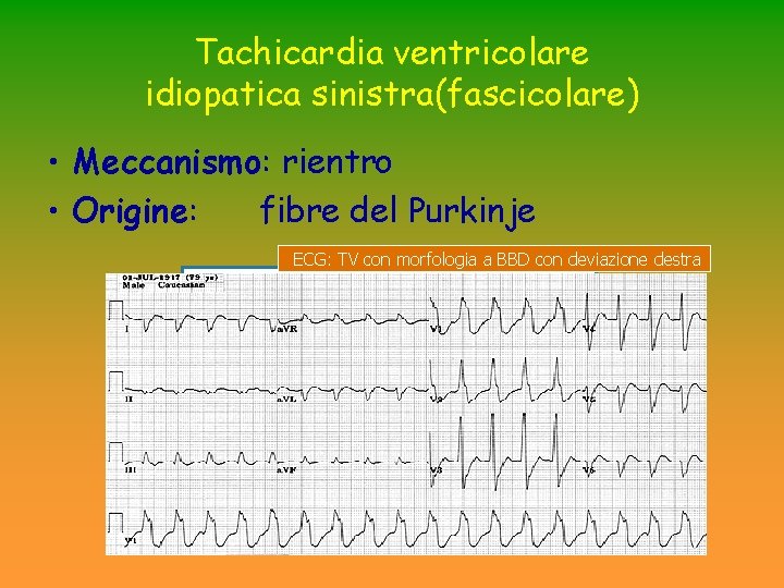 Tachicardia ventricolare idiopatica sinistra(fascicolare) • Meccanismo: rientro • Origine: fibre del Purkinje ECG: TV Tachicardia ventricolare idiopatica sinistra(fascicolare) • Meccanismo: rientro • Origine: fibre del Purkinje ECG: TV