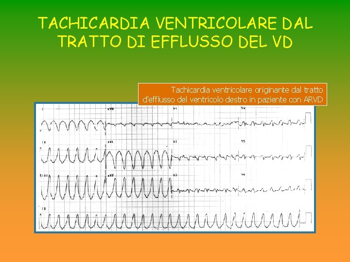 TACHICARDIA VENTRICOLARE DAL TRATTO DI EFFLUSSO DEL VD Tachicardia ventricolare originante dal tratto d’efflusso TACHICARDIA VENTRICOLARE DAL TRATTO DI EFFLUSSO DEL VD Tachicardia ventricolare originante dal tratto d’efflusso