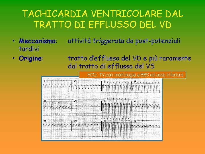 TACHICARDIA VENTRICOLARE DAL TRATTO DI EFFLUSSO DEL VD • Meccanismo: tardivi • Origine: attività TACHICARDIA VENTRICOLARE DAL TRATTO DI EFFLUSSO DEL VD • Meccanismo: tardivi • Origine: attività