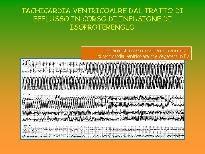 TACHICARDIA VENTRICOALRE DAL TRATTO DI EFFLUSSO IN CORSO DI INFUSIONE DI ISOPROTERENOLO Durante stimolazione TACHICARDIA VENTRICOALRE DAL TRATTO DI EFFLUSSO IN CORSO DI INFUSIONE DI ISOPROTERENOLO Durante stimolazione