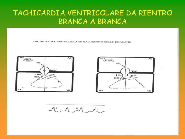 TACHICARDIA VENTRICOLARE DA RIENTRO BRANCA A BRANCA TACHICARDIA VENTRICOLARE DA RIENTRO BRANCA A BRANCA