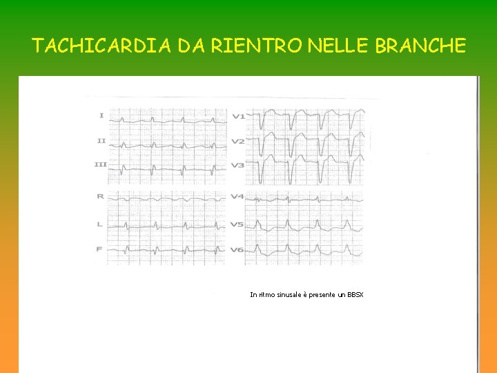 TACHICARDIA DA RIENTRO NELLE BRANCHE In ritmo sinusale è presente un BBSX TACHICARDIA DA RIENTRO NELLE BRANCHE In ritmo sinusale è presente un BBSX