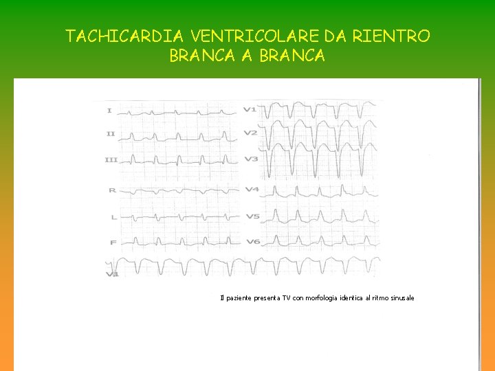 TACHICARDIA VENTRICOLARE DA RIENTRO BRANCA A BRANCA Il paziente presenta TV con morfologia identica TACHICARDIA VENTRICOLARE DA RIENTRO BRANCA A BRANCA Il paziente presenta TV con morfologia identica