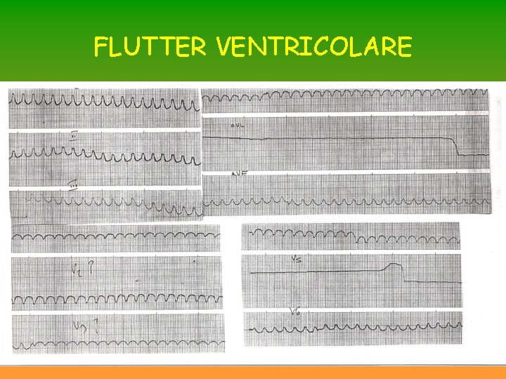 FLUTTER VENTRICOLARE FLUTTER VENTRICOLARE