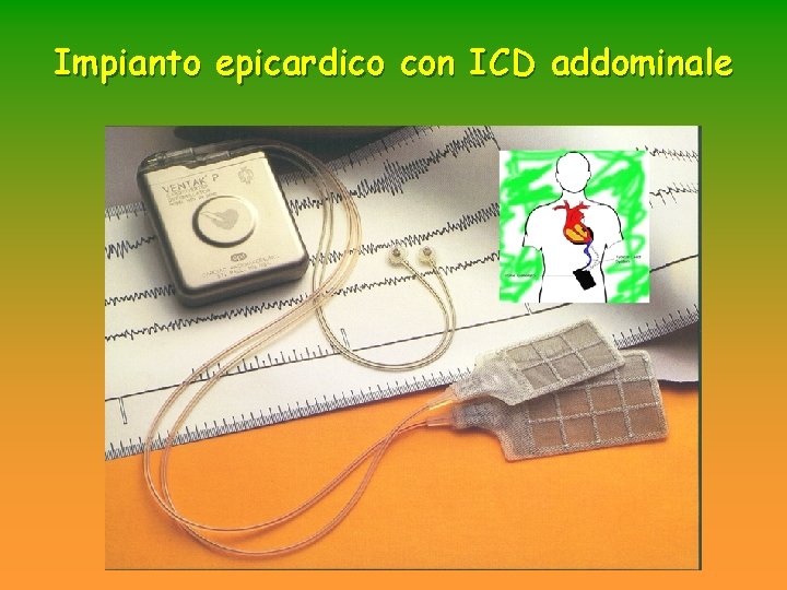 Impianto epicardico con ICD addominale Impianto epicardico con ICD addominale