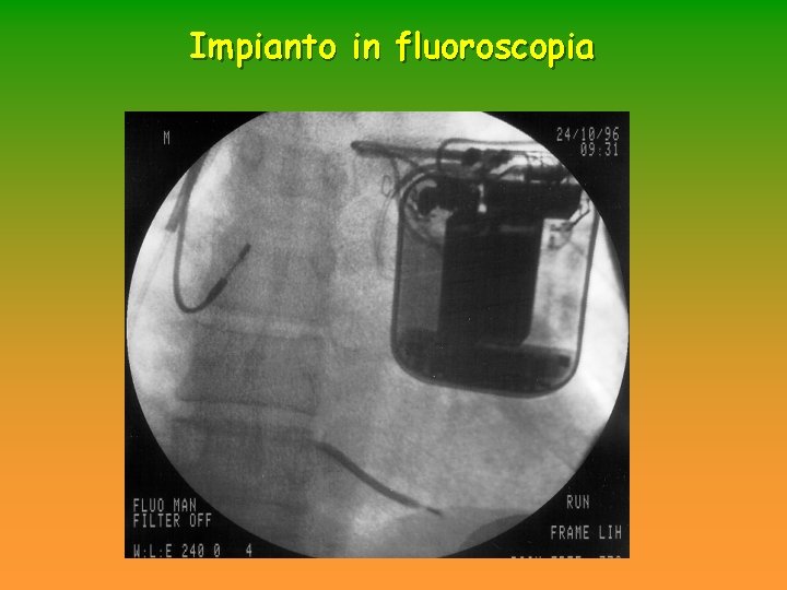 Impianto in fluoroscopia Impianto in fluoroscopia