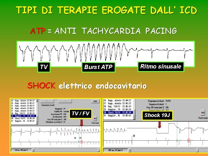 TIPI DI TERAPIE EROGATE DALL’ ICD ATP = ANTI TACHYCARDIA PACING TV Burst ATP TIPI DI TERAPIE EROGATE DALL’ ICD ATP = ANTI TACHYCARDIA PACING TV Burst ATP