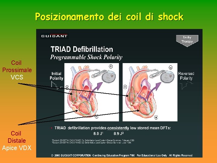 Posizionamento dei coil di shock Coil Prossimale VCS Coil Distale Apice VDX Posizionamento dei coil di shock Coil Prossimale VCS Coil Distale Apice VDX