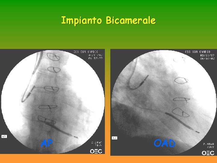 Impianto Bicamerale AP OAD Impianto Bicamerale AP OAD
