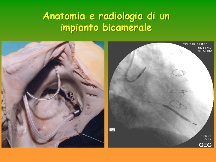 Anatomia e radiologia di un impianto bicamerale Anatomia e radiologia di un impianto bicamerale