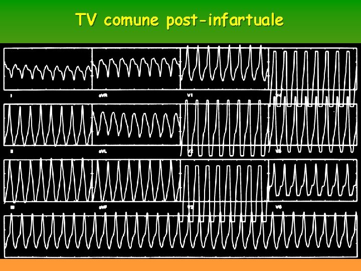 TV comune post-infartuale TV comune post-infartuale