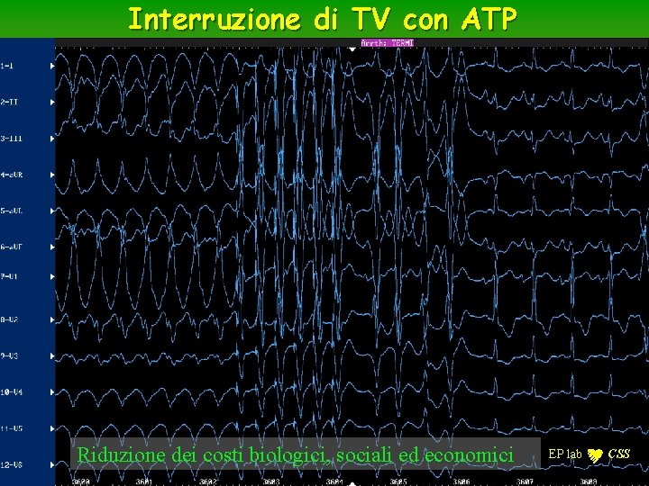Interruzione di TV con ATP Riduzione dei costi biologici, sociali ed economici EP lab Interruzione di TV con ATP Riduzione dei costi biologici, sociali ed economici EP lab