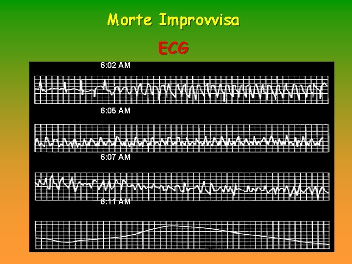 Morte Improvvisa ECG 6: 02 AM 6: 05 AM 6: 07 AM 6: 11 Morte Improvvisa ECG 6: 02 AM 6: 05 AM 6: 07 AM 6: 11