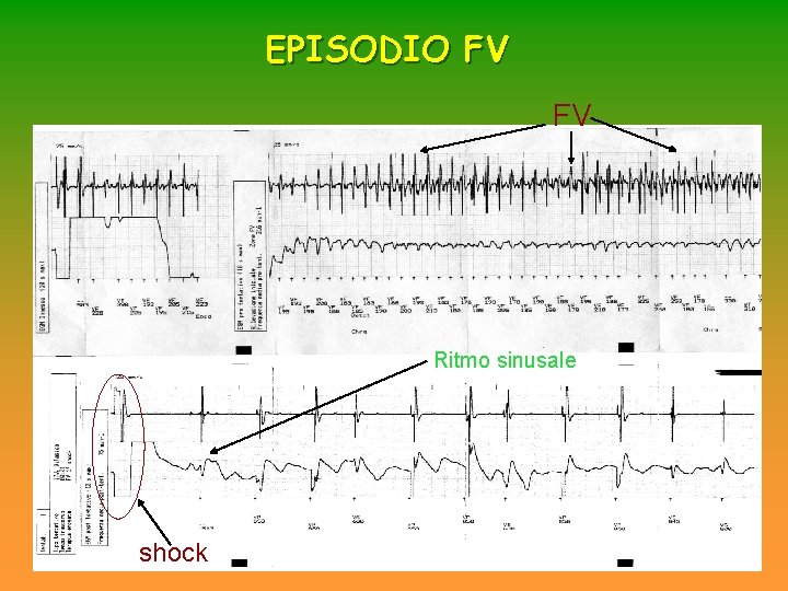 EPISODIO FV FV Ritmo sinusale shock EPISODIO FV FV Ritmo sinusale shock