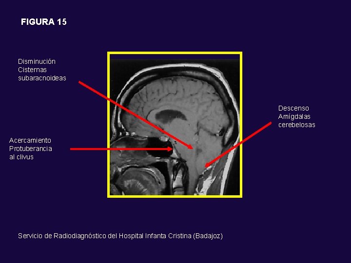 FIGURA 15 Disminución Cisternas subaracnoideas Descenso Amígdalas cerebelosas Acercamiento Protuberancia al clivus Servicio de