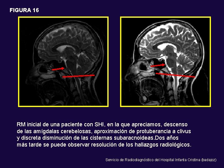 FIGURA 16 RM inicial de una paciente con SHI, en la que apreciamos, descenso