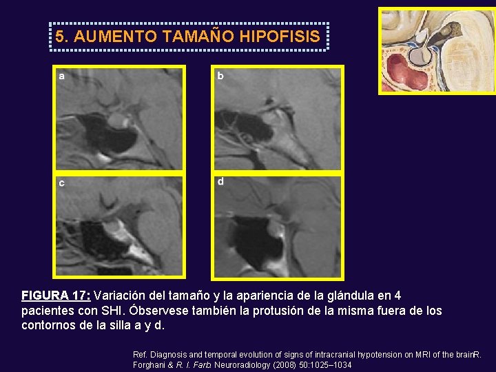 5. AUMENTO TAMAÑO HIPOFISIS FIGURA 17: Variación del tamaño y la apariencia de la