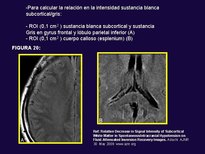 -Para calcular la relación en la intensidad sustancia blanca subcortical/gris: - ROI (0, 1