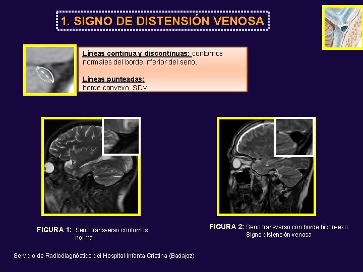 1. SIGNO DE DISTENSIÓN VENOSA Líneas continua y discontinuas: contornos normales del borde inferior