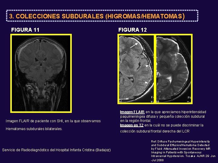 3. COLECCIONES SUBDURALES (HIGROMAS/HEMATOMAS) FIGURA 11 Imagen FLAIR de paciente con SHI, en la