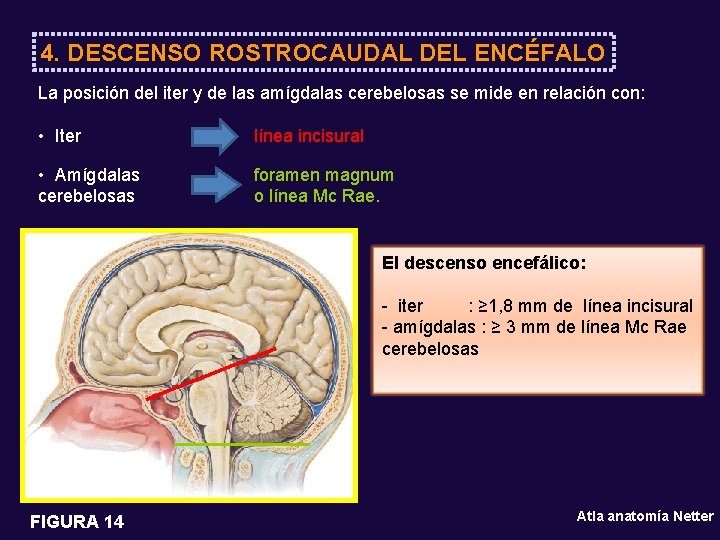 4. DESCENSO ROSTROCAUDAL DEL ENCÉFALO La posición del iter y de las amígdalas cerebelosas