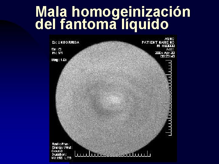 Mala homogeinización del fantoma líquido 