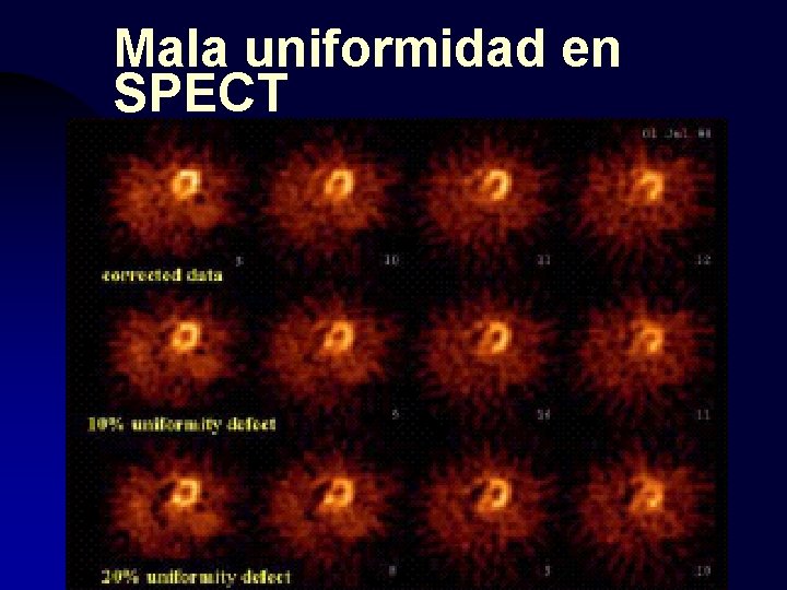 Mala uniformidad en SPECT 