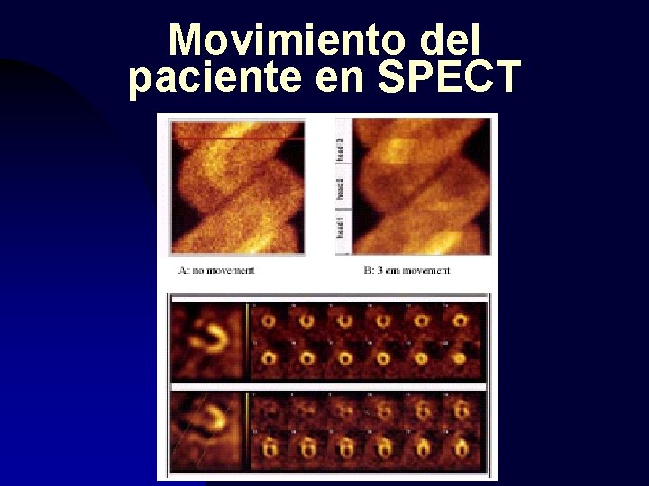 Movimiento del paciente en SPECT 