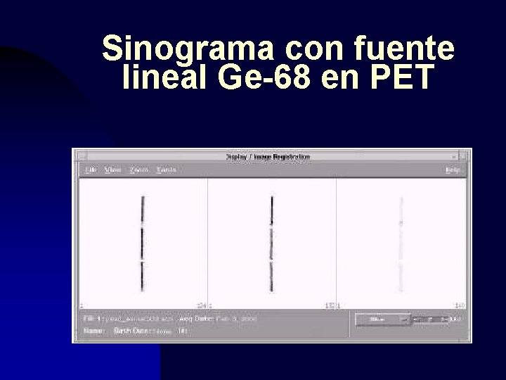 Sinograma con fuente lineal Ge-68 en PET 